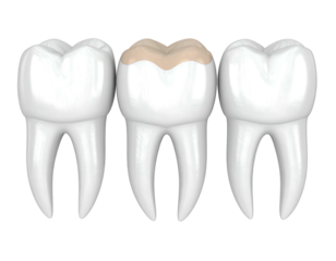 Three white teeth, the center one decayed with a tan-colored lesion on its biting surface, isolated on a black background