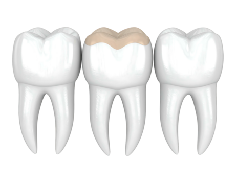 Three white teeth, the center one decayed with a tan-colored lesion on its biting surface, isolated on a black background