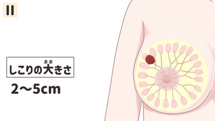 Breast cancer Stage 2 diagram Human anatomy PNG