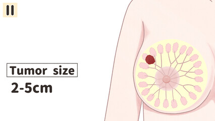 Breast cancer Stage 2 diagram Human anatomy PNG