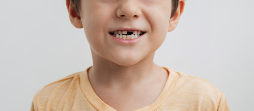 The smile of a little boy without a baby tooth. Panoramic banner. The child's front baby tooth falls out and a new adult tooth grows. Oral care in children.