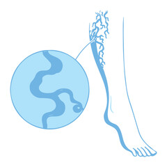 Varicose Veins Illustration