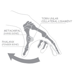 Hand Ligament Injury Diagram