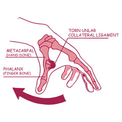 Thumb Ligament Injury Diagram