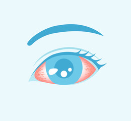  Conjunctivitis (pink eye) vector illustration