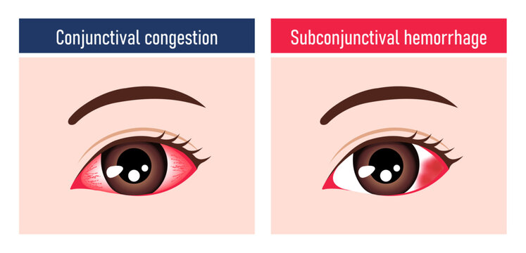 Illustration comparing subconjunctival hemorrhage and conjunctival congestion