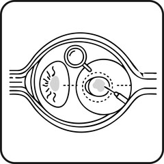 Eye Cataract Surgery