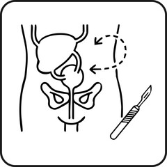 Prostatectomy