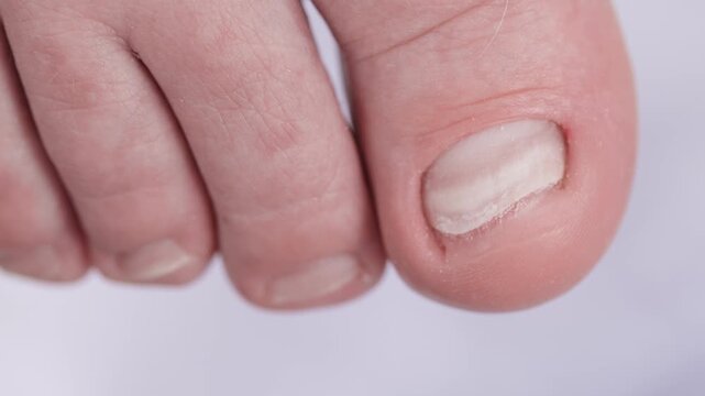 Close-up of caucasian adult's toes on light surface problematic ingrown toenail, top view.