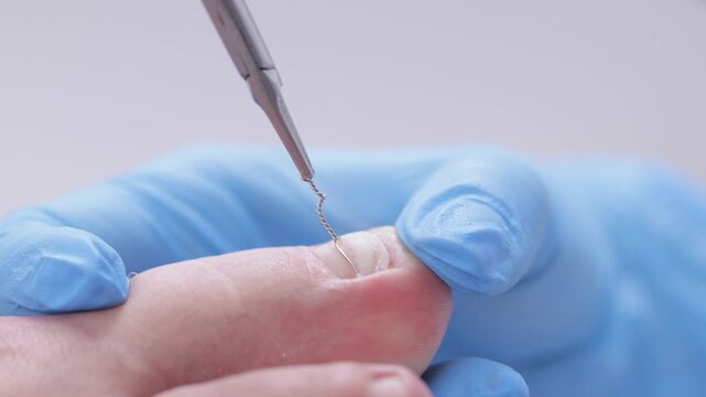 Close-up of ingrown toenail correction with brace by gloved hands.