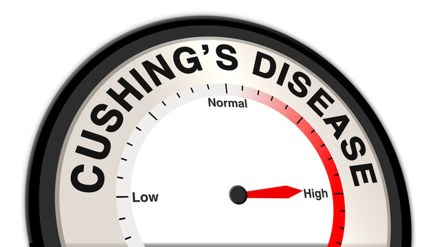Cushing's disease at high severity displayed on a barometer or tachometer, indicating severe hormonal imbalance, urgent need for medical intervention, and intensive care management