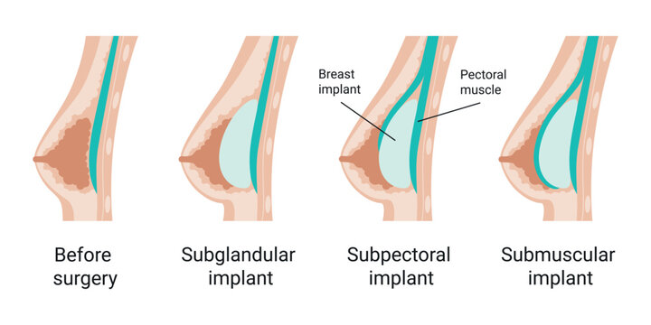 Breast anatomy before Surgery. Subglandular and submuscular placement types. Flat vector illustration