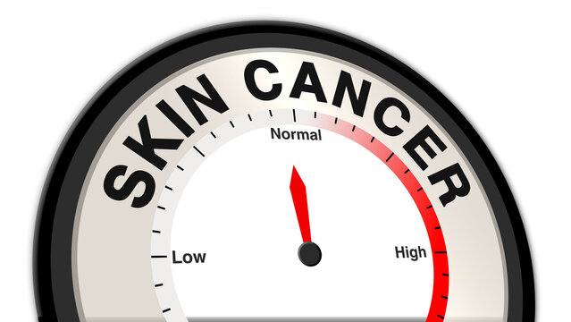 Skin cancer at a moderate level displayed on a barometer or tachometer, reflecting noticeable lesions or growths, with ongoing treatment, monitoring, and early intervention to prevent spread