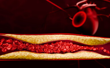 Cholesterol Plaque Causing Artery Blockage Leading to Heart Disease and Ischemia Medical Anatomy 3D Rendering