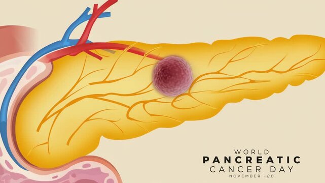 World Pancreatic Cancer Day.  Pancreatic Cancer concept Animation video.