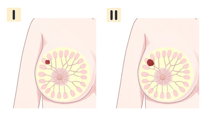Breast cancer Stages Medical diagram PNG