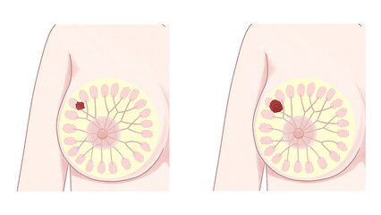 Blank Breast cancer Stages Medical diagram PNG