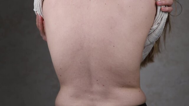 Skin spots of ring-shaped centrifugal erythema Darya on the back of a young woman