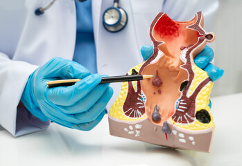 Asian doctor with rectum and hemorrhoid human anatomy model at hospital, inflamed vascular structure.