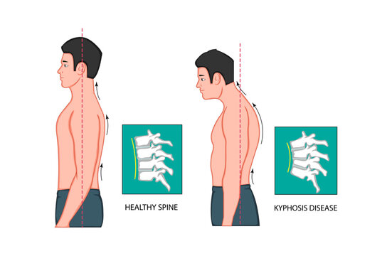 Spine Forward Head Posture Chest Xray Stock Vector Illustration