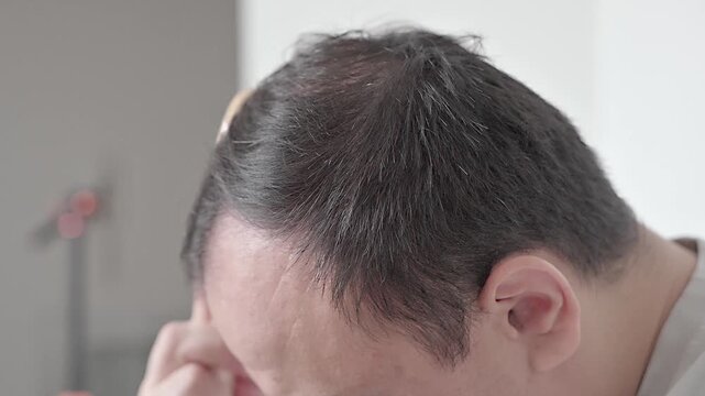 Androgenic alopecia, hair loss, male pattern baldness, man showing his visible bald area. High quality 4k footage