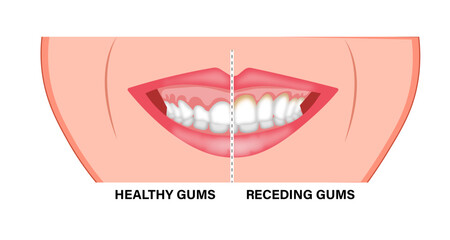 Gingivectomy Gum Graft Smile Small Teeth 