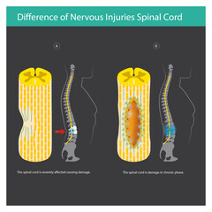Acute and Chronic Spinal Cord Injury
This diagram illustrates the difference between an acute (A) and chronic (B) spinal cord injury. 