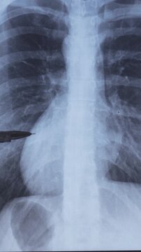 Doctor learning vertical X-ray of humans chest and inside soft tissues.