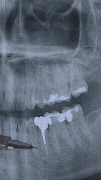 Vertical dental X-Ray of humans teeth with diseased teeth, dental fillings, crowns, sealants.