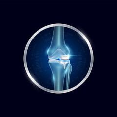 Artificial joints in circle frame label aluminum. Partial knee replacement or Prosthetic implant. Orthopedic technology surgery for treatment arthritis damaged cartilage. Medical product vector.