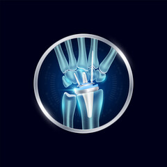 Artificial joints in circle frame label aluminum. Wrist replacement or Prosthetic implant. Orthopedic technology surgery for treatment arthritis damaged cartilage. Medical product vector.