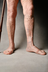 Varicose veins on a female legs. Legs of an elderly woman with a walking stick