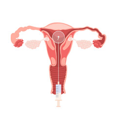 Female uterus. Female Reproductive System. In Vitro Fertilization (IVF) Medical Procedure. Medical education diagram for use in infographics on gynecology.