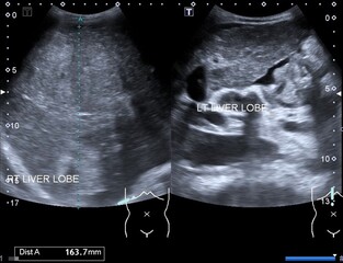 ultrasonography cirrhotic liver