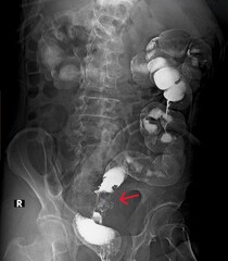 Xray imaging of  colon carcinoma barium enema contrast study	
