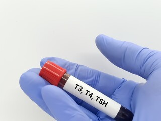 Doctor holds blood sample for hormonal examination of thyroid gland in laboratory. T3, T4, TSH, test. Medical testing concept.