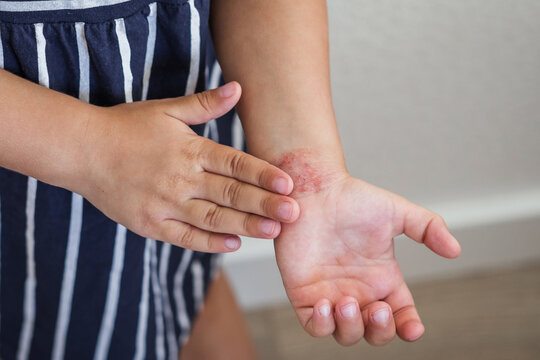 Close-up of child s hands with red irritated skin atopic dermatitis on the wrist, showing symptoms allergy, inflammation, sensitivity, highlighting dermatological problems and need for skin treatment