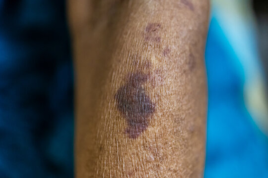 skin allergy closeup of elderly forearm with visible dark purple bruise and small red patches