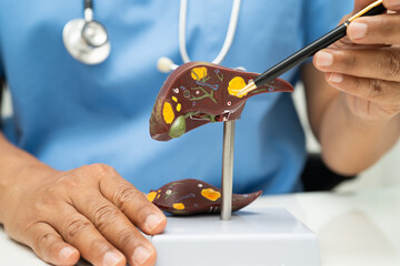 Cirrhosis, Liver cancer, fatty liver, Asian doctor with liver human anatomy model in World...