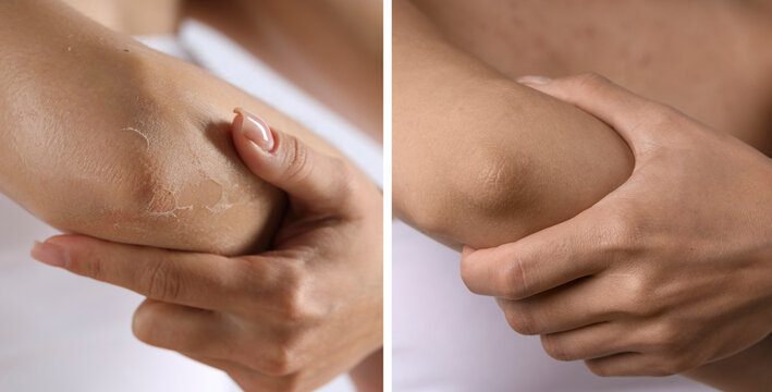 Woman with dry skin on elbow before and after moisturizing treatment, closeup. Collage of photos