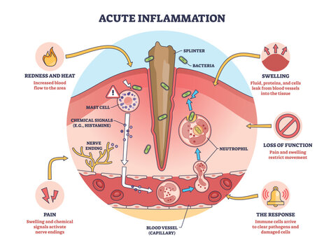Acute inflammation overview, skin injury with splinter, neutrophils in blood vessels, and mast cell signals explain redness, swelling, pain, loss of function. Outline diagram