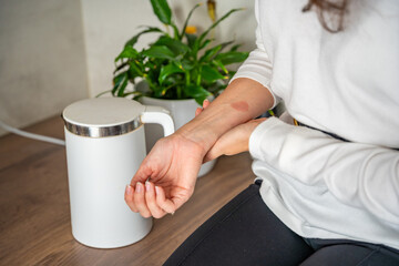 Scald burn on a hand caused by steam from a kettle in a kitchen. Domestic accident illustrating the...