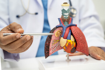 Pneumonia, lung cancer, Asian doctor holding human anatomy model for study diagnosis and treatment in hospital.