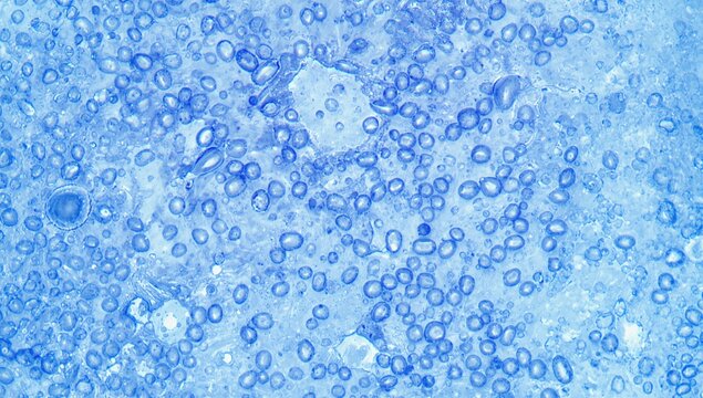 Microscopic view at 100X magnification of a sputum sample stained by Gram method showing white blood cells and many gram-positive rod-shaped bacteria (Selective focus).