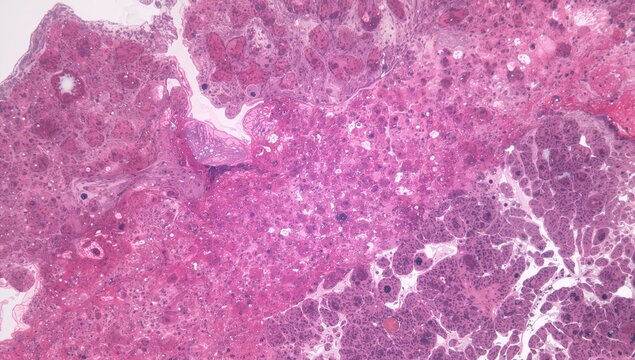 Benign Lipoma Growth in Arm Area, Detailed Microscopic View of Fat Cells in Tumor Structure