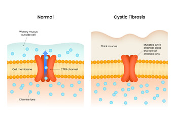 Cystic Fibrosis Normal vs Mutated CFTR Channel Function
