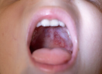 Oral lesions showing hand foot and mouth disease
