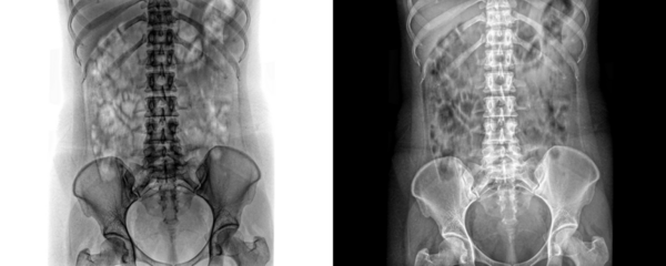 Abdomen Kub Projection X-Ray Image Showing Internal Organs and Skeletal Anatomy for Abdominal Pain Assessment Isolated on Transparent or White Background for Medical Study