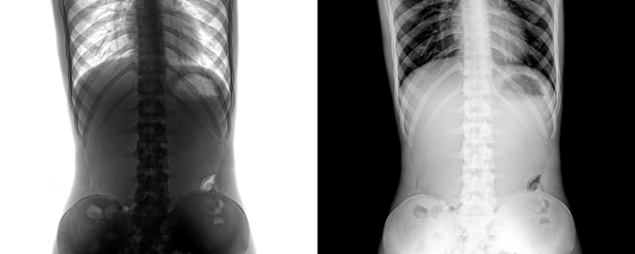Anterior Projection X-Ray of Abdomen Showing Detailed Abdominal Cavity and Skeletal Framework for Pain Assessment Isolated on Transparent or White Background