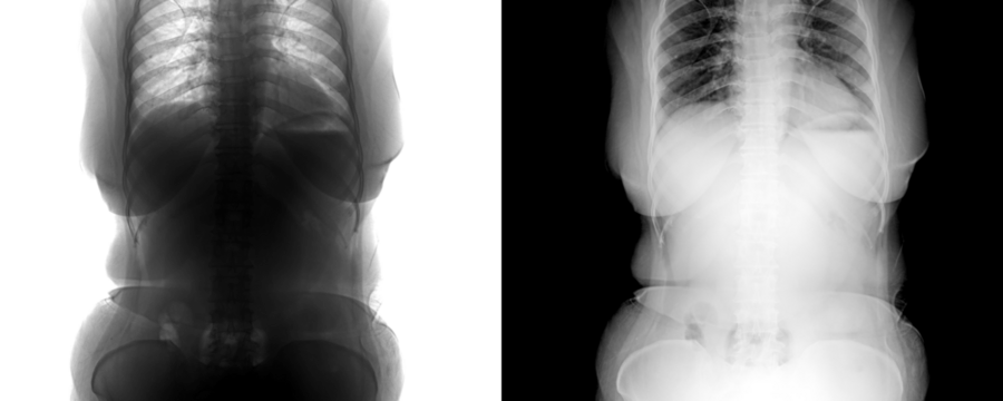 High Resolution Abdomen X-Ray in Anterior View Displaying Abdominal Organs and Bone Structure for Pain Diagnosis, Isolated on Transparent or White Background